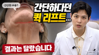 V라인 만들려다... 안면거상술 부작…
