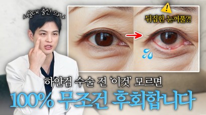 하안검 수술부터 받으면 100% 후회…