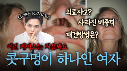 콧 구멍이 하나가 된 여자의 사연