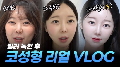 현직 성형외과 직원의 코수술 브이로그