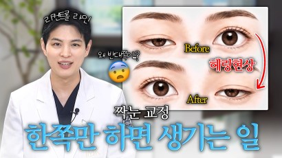 짝눈교정 헤링현상 리컨트롤 라인교정으…